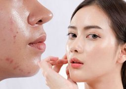 Khám Phá Danh Sách Serum Trị Mụn Thâm Cho Da Dầu Tốt Nhất