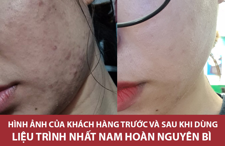 Làn da của chị Thùy đã thực sự được hồi sinh sau 3 tháng dùng Nhất Nam Hoàn Nguyên Bì đều đặn