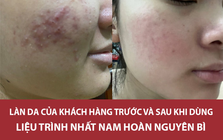 Làn da của khách hàng Hoài Phương có thay đổi tích cực sau khi dùng Nhất Nam Hoàn Nguyên Bì