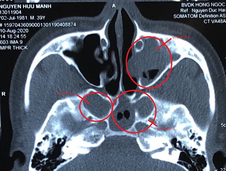 polyp mui xoang