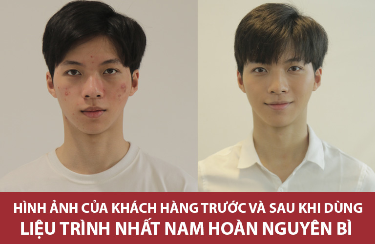 khách hàng hiếu trị mụn