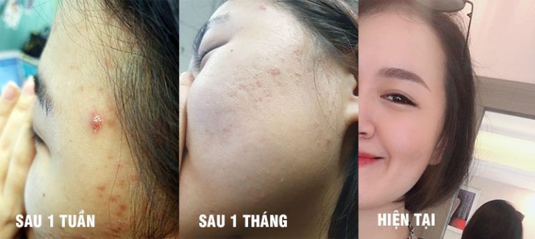 Sự thay đổi của chị Phương Thùy khi dùng liệu trình trị mụn Nhất Nam Hoàn Nguyên Bì