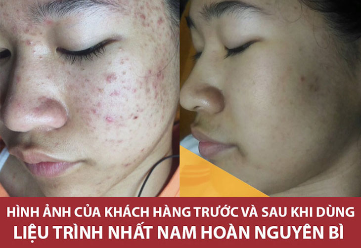 Hình ảnh trước và sau khi trị mụn của bạn Phương Liên