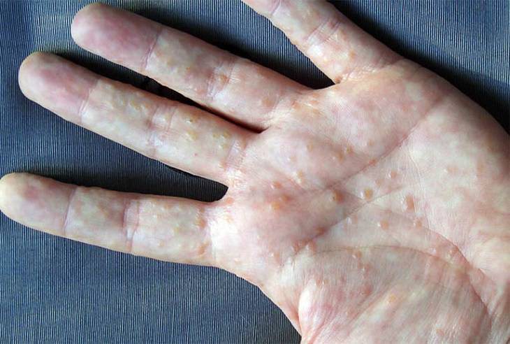 Bệnh tổ đỉa cần điều trị sớm để tránh lan rộng ra vùng da xung quanh