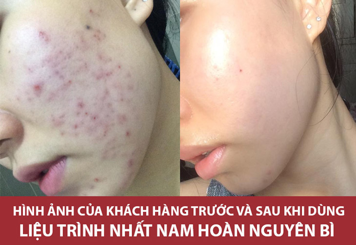 Khách hàng Hoàng Thị Uyên với làn da sáng đẹp, sạch mụn sau khi điều trị tại Trung tâm Da liễu Đông y Việt Nam