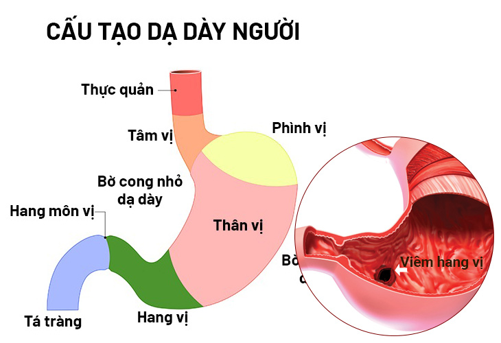 Hình ảnh viêm hang vị dạ dày