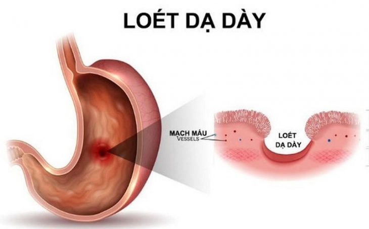 Vi khuẩn Hp dễ khiến dạ dày bị viêm loét