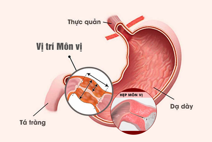 Viêm hang vị dạ dày có thể gây hẹp môn vị