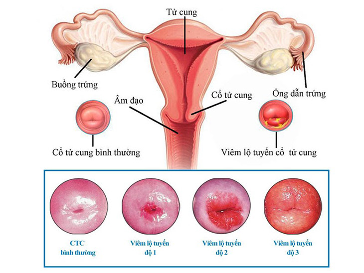 Viêm lộ tuyến cổ tử cung độ 1, 2, 3 