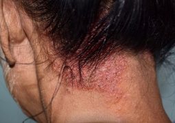 Nhiễm khuẩn (tụ cầu, liên cầu), nhiễm nấm da, nhiễm virus khiến bệnh nghiêm trọng hơn