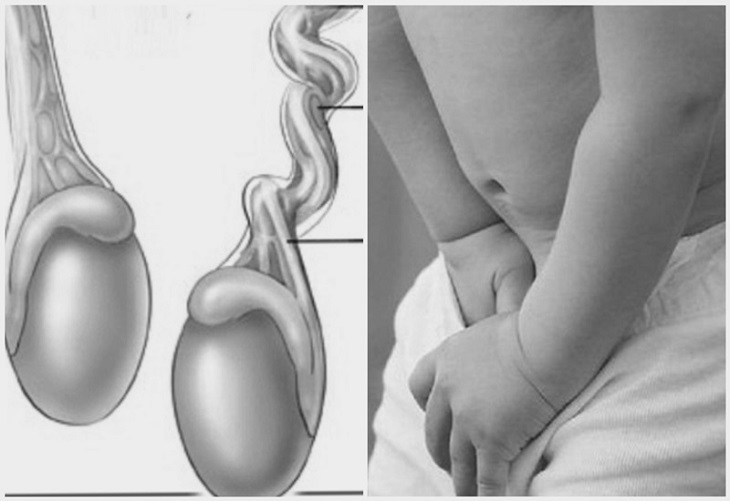 Bệnh tràn dịch màng tinh hoàn ở trẻ sơ sinh