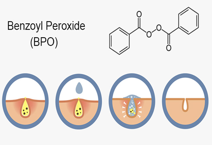 benzoyl peroxide la gi