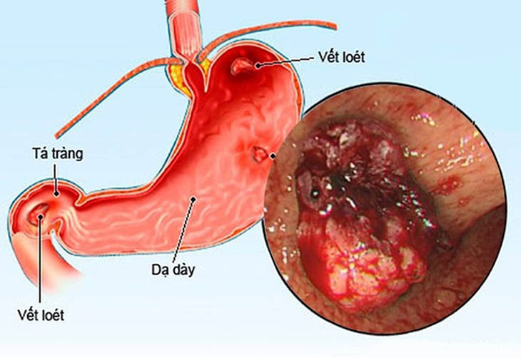 Tại Việt Nam có tới 26% dân số mắc bệnh viêm loét dạ dày tá tràng