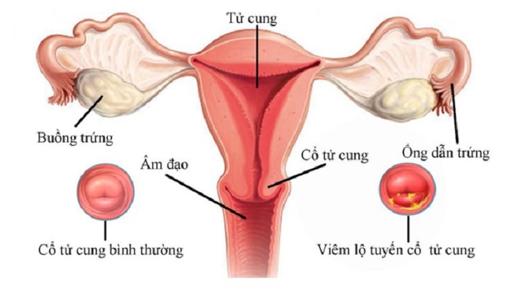 Huyết trắng kèm máu có thể là dấu hiệu mắc bệnh viêm lộ tuyến cổ tử cung