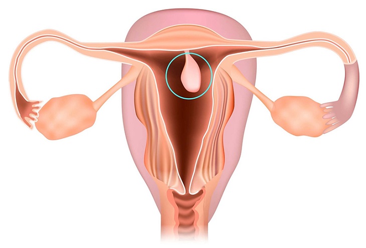 Polyp cổ tử cung là sự hình thành cục u bên trong nội mạc tử cung