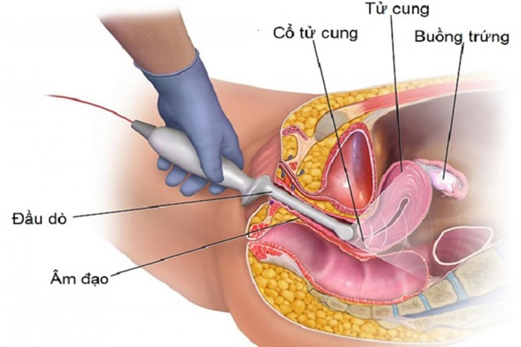 Siêu âm đầu dò giúp phát hiện, đánh giá các vấn đề bất thường tại bộ phận sinh sản của nữ giới