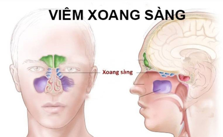 Chữa viêm xoang sàng tại nhà giúp kiểm soát bệnh tốt hơn