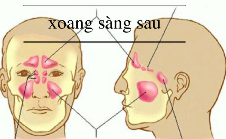 Hình ảnh xoang sàng sau