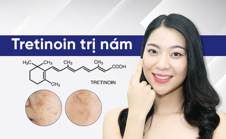 Dùng Tretinoin, Retinoids trị nám da theo chỉ định của bác sĩ