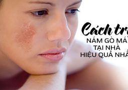 12 Cách Trị Nám Gò Má Tại Nhà Cho Hiệu Quả Tốt Nhất