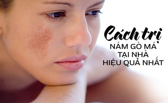 12 Cách Trị Nám Gò Má Tại Nhà Cho Hiệu Quả Tốt Nhất