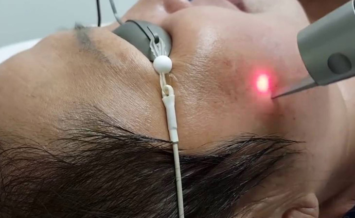 Điều trị nám bằng laser là một công nghệ loại bỏ nám hiện đại