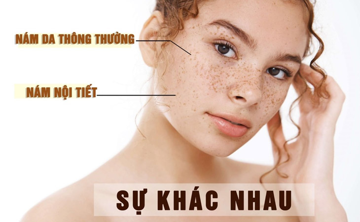 Sự khác nhau giữa nám thông thường và nám nội tiết