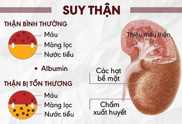 Suy thận là tình trạng mà chức năng của thận bị suy giảm