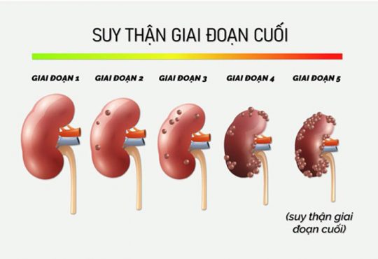 Các Giai Đoạn Suy Thận: Cách Nhận Biết và Quản Lý Hiệu Quả