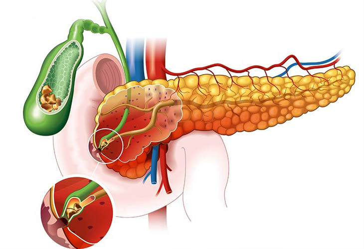 Bài thuốc giúp trị sỏi thận, sỏi mật hiệu quả