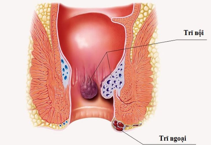 Huyệt đạo giúp hỗ trợ điều trị bệnh trĩ hiệu qủa