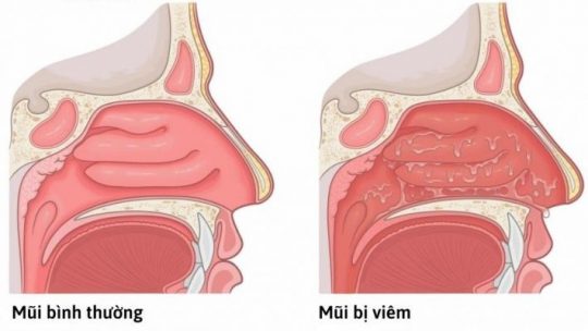 Xử lý các triệu chứng viêm mũi dị ứng