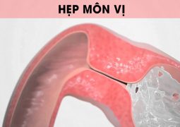 Hẹp môn vị