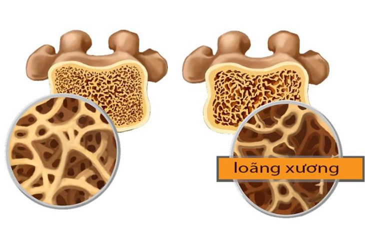 Bạn có thể dùng dâm dương hoắc để hỗ trợ điều trị bệnh loãng xương