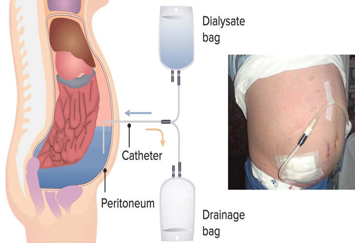 Lọc màng bụng liên tục ngoại trú (Continuous Ambulatory Peritoneal Dialysis - CAPD)