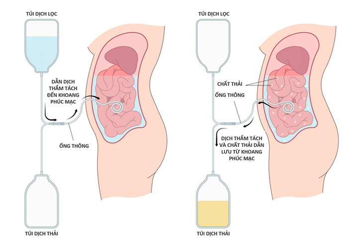 Lọc màng bụng liên tục chu kỳ