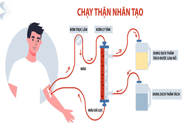 Phương pháp chạy thận nhân tạo