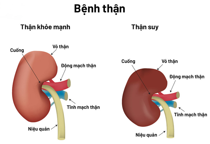 Suy thận là bệnh lý khá phổ biến hiện nay