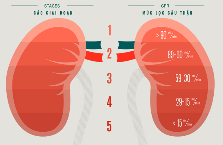 Suy thận độ 1 được hiểu là giai đoạn đầu của bệnh suy thận mạn tính