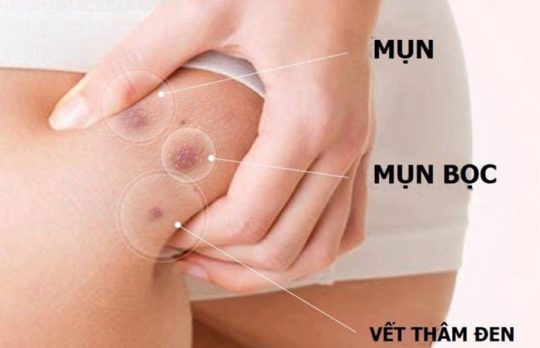 7 Loại Thuốc Trị Mụn Mông Được Bác Sĩ Khuyên Dùng