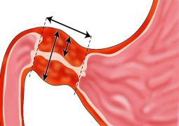 Hẹp môn vị ngăn cản quá trình vận chuyển của thức ăn trong hệ tiêu hóa