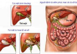 Thấm mật phúc mạc và viêm phúc mạc mật: Do tình trạng tắc đường mật và nhiễm trùng do sỏi