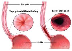 Barret thực quản gặp ở 8-15% bệnh nhân, có thể tiềm ẩn nguy cơ thành tế bào ung thư