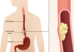 Ung thư biểu mô tuyến thực quản, phát sinh phần lớn do Barret thực quản