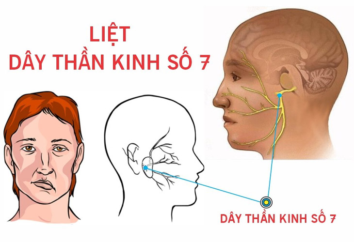 Hình ảnh liệt dây thần kinh số 7