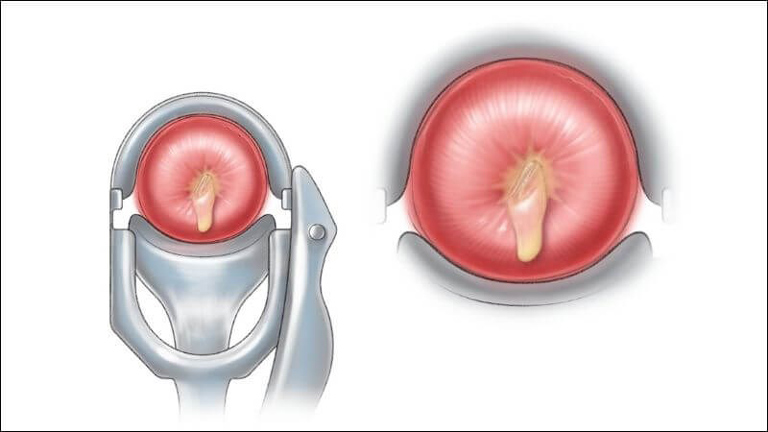 Viêm cổ tử cung khiến chị Thanh Hoa khổ sở trong nhiều năm liền