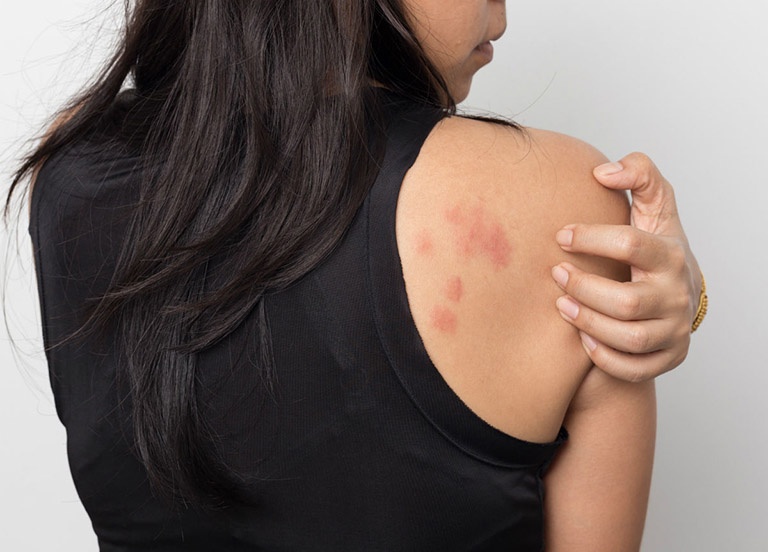 Mề đay, mẩn ngứa cần điều trị từ gốc để hạn chế nguy cơ tái phát và kiểm soát triệu chứng một cách tốt nhất