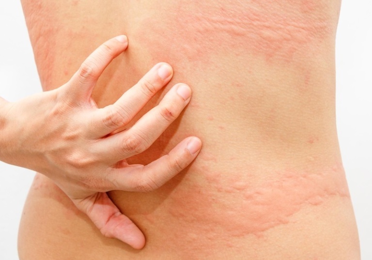 Mề đay, mẩn ngứa là bệnh lý khiến nhiều người bệnh khổ sở