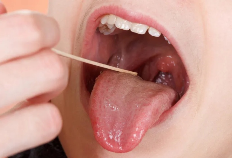 Viêm amidan gây ra những ảnh hưởng tiêu cực đến sức khỏe