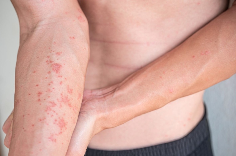 Cần xác định căn nguyên gây bệnh để từ đó điều trị viêm da hiệu quả